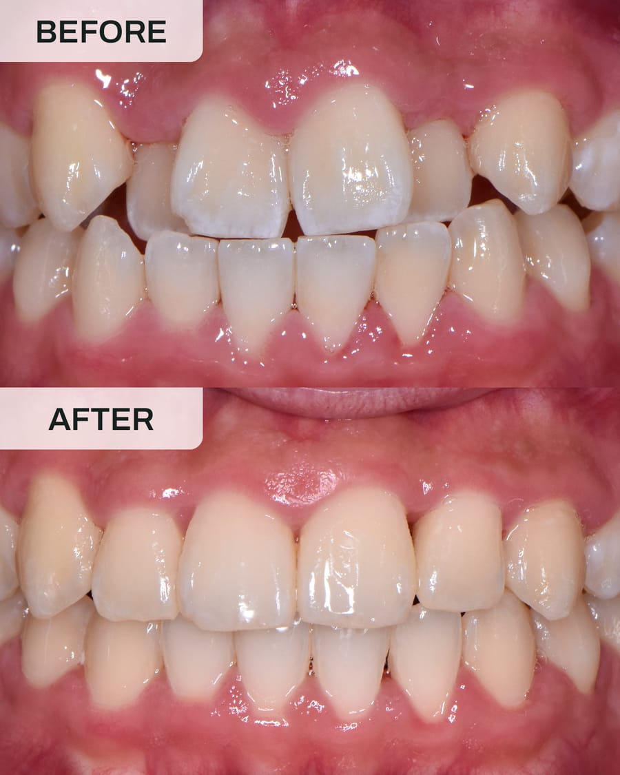Before and after orthodontic treatment at Alpha Dental, Sutera Utama, case 3