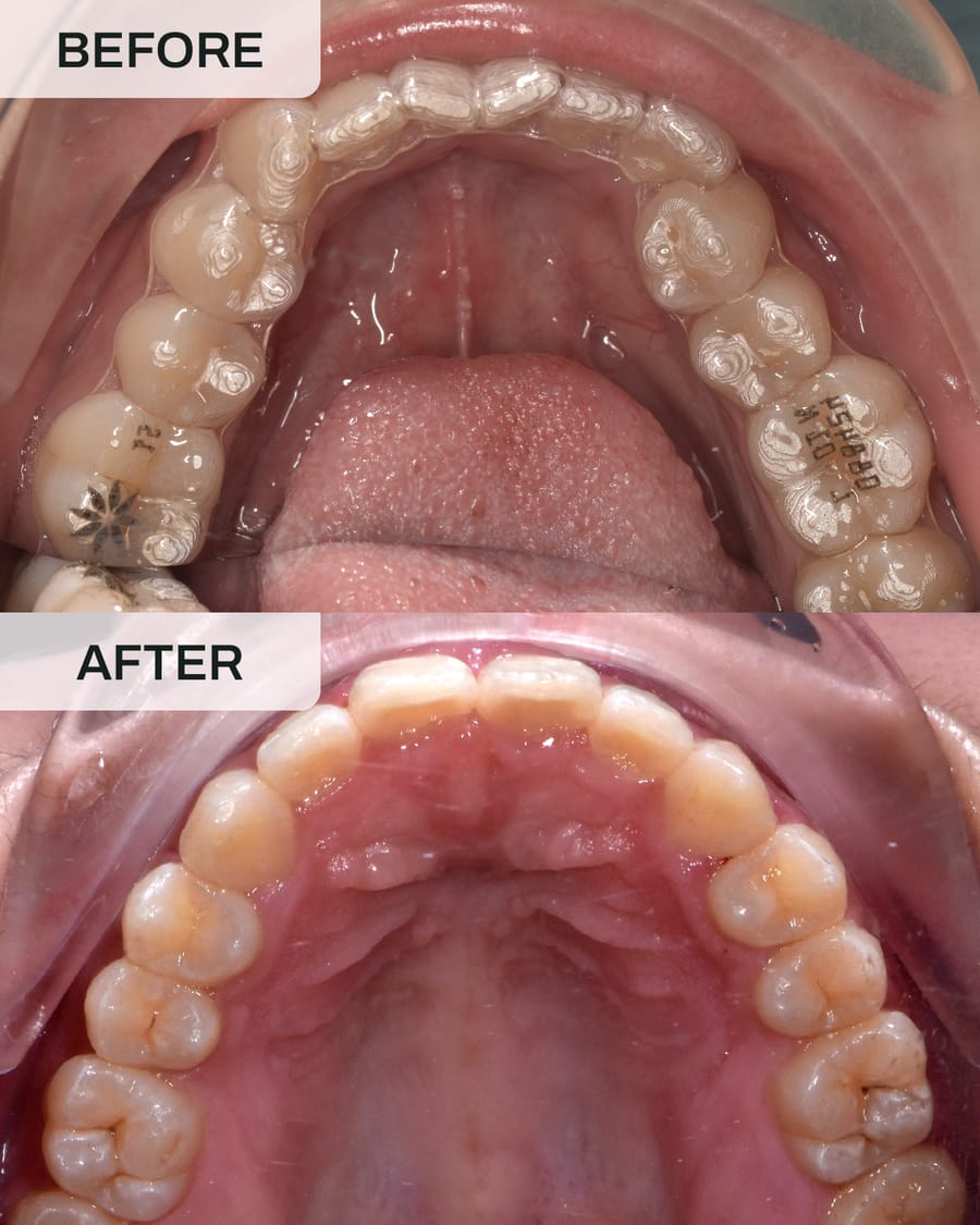 Before and after Invisalign treatment at Alpha Dental, Sutera Utama, case 4